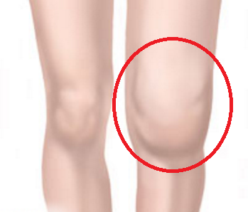 変形性膝関節症について かとう整形外科スポーツ運動器クリニック